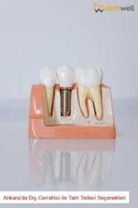 Ankara’da Diş Cerrahisi ile Tam Tedavi Seçenekleri