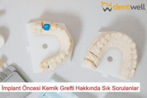 İmplant Öncesi Kemik Grefti Hakkında Sık Sorulanlar