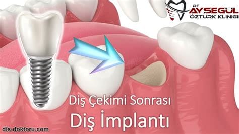 Sağlıklı Bir Gülümseme İçin Şimdi Harekete Geçin: Dentwell Diş Kliniği Yanınızda - Ankara, Mamak