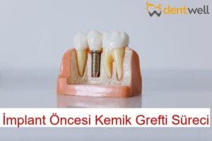 İmplant Öncesi Kemik Grefti Süreci
