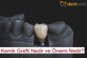 Kemik Grefti Nedir ve Önemi Nedir?